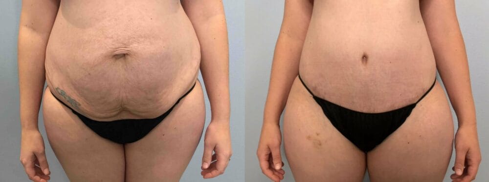 Tummy Tuck Patient 66