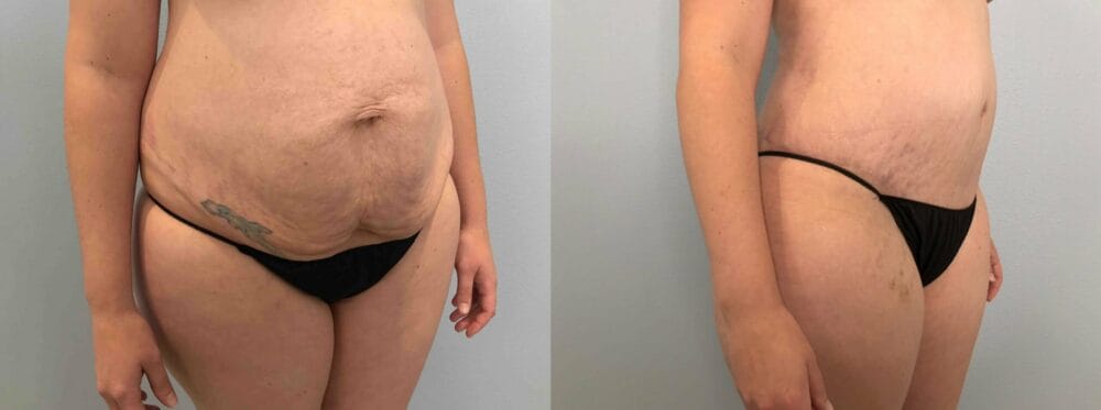 Tummy Tuck Patient 66 left angle view