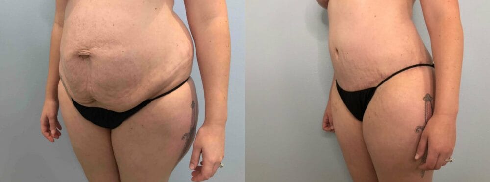 Tummy Tuck Patient 66 right angle view