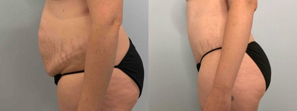 Tummy Tuck Patient 66 right view