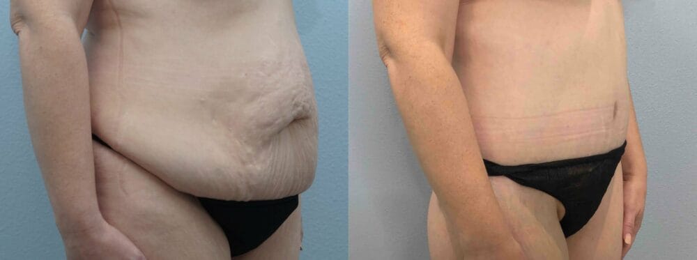 tummy tuck patient 69 left angle view