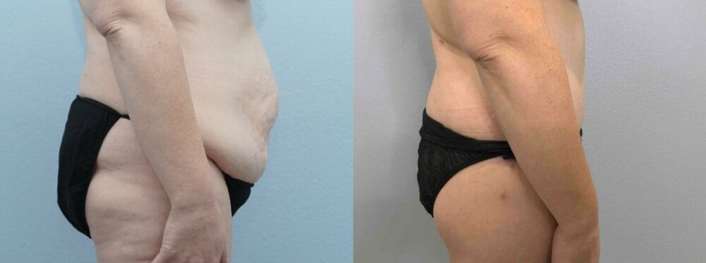 tummy tuck patient 69 left view