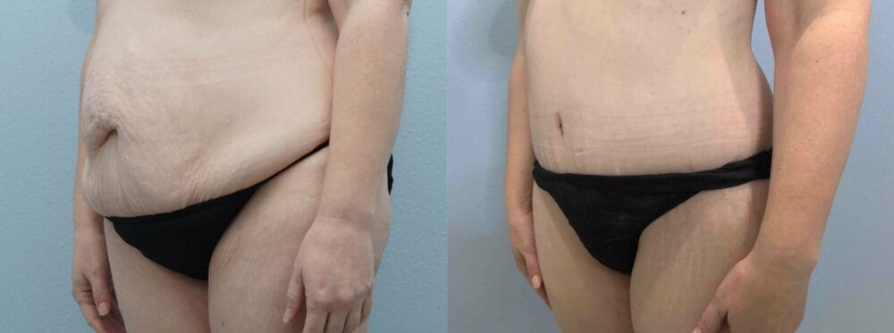 tummy tuck patient 69 right angle view