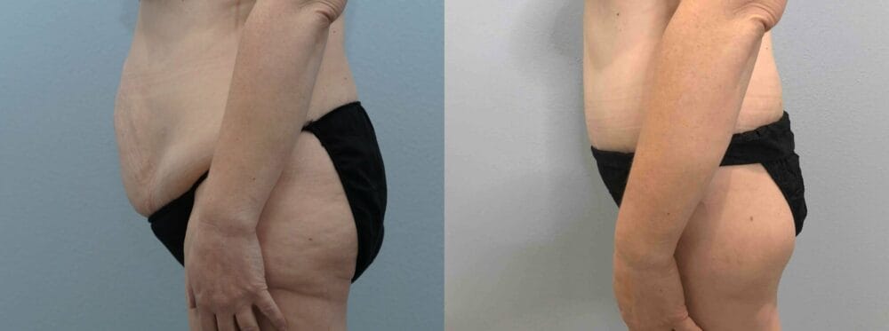 tummy tuck patient 69 right view