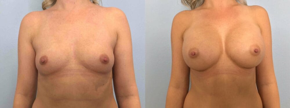 Breast Augmentation Patient 82 front view