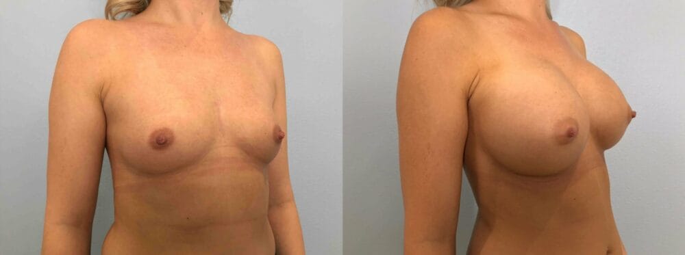 Breast Augmentation Patient 82 left angle view