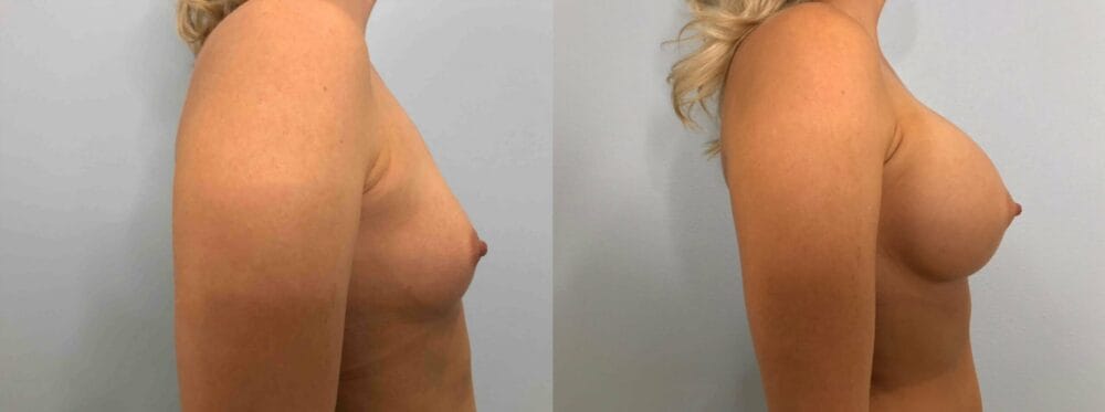 Breast Augmentation Patient 82 left view