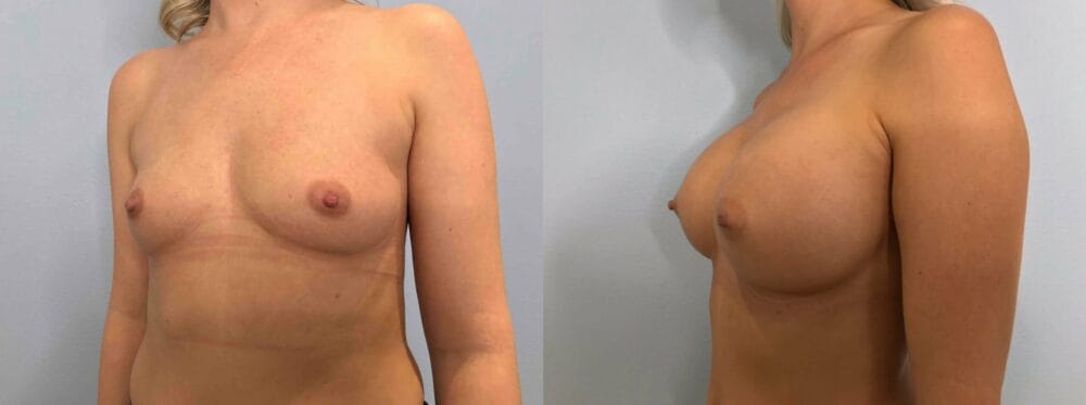 Breast Augmentation Patient 82 right angle view