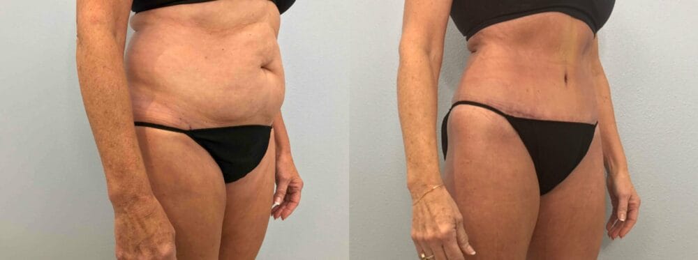 Tummy Tuck Patient 63 left angle view
