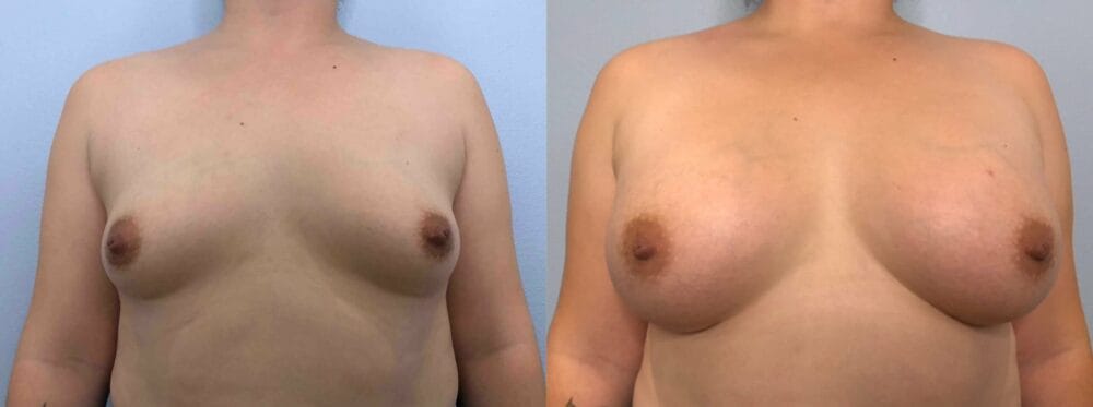 Breast Augmentation Patient 86 front view