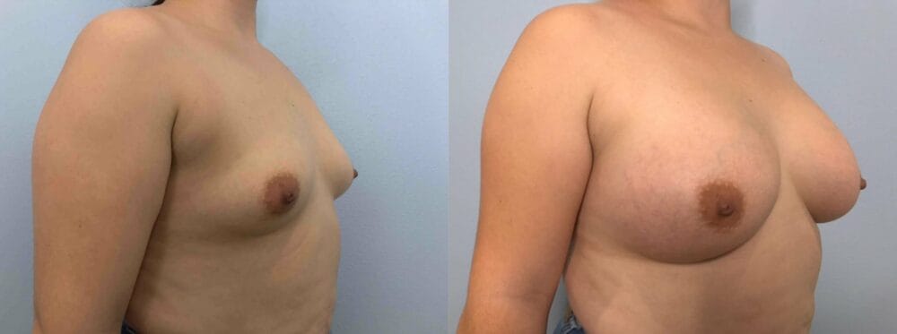 Breast Augmentation Patient 86 left angle view