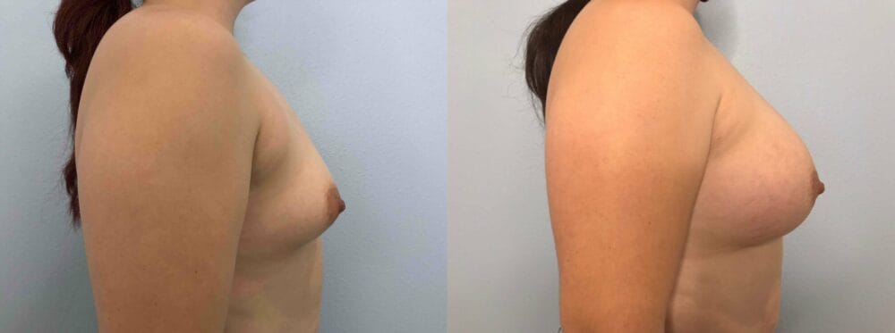 Breast Augmentation Patient 86 left view