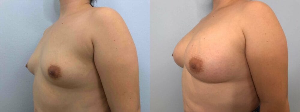 Breast Augmentation Patient 86 right angle view