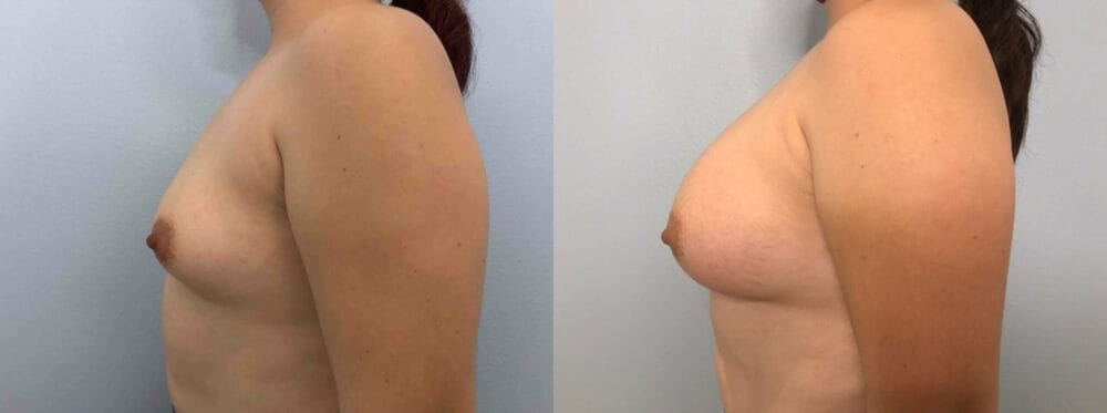 Breast Augmentation Patient 86 right view