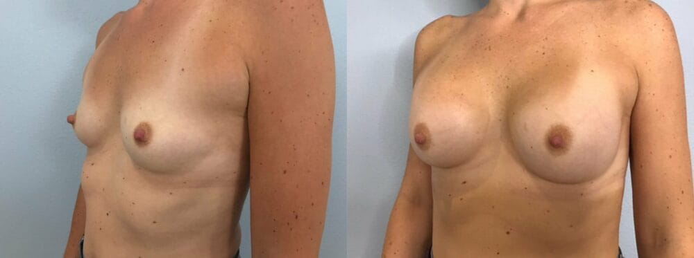 Breast Augmentation Patient 88 right angle view