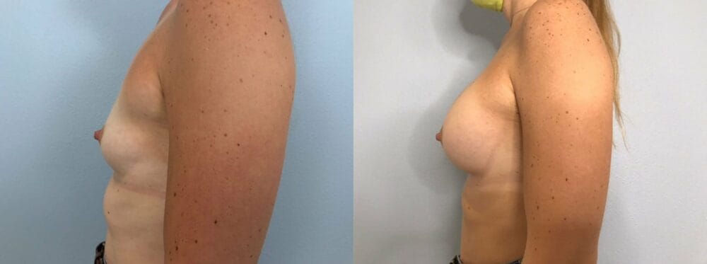 Breast Augmentation Patient 88 right view