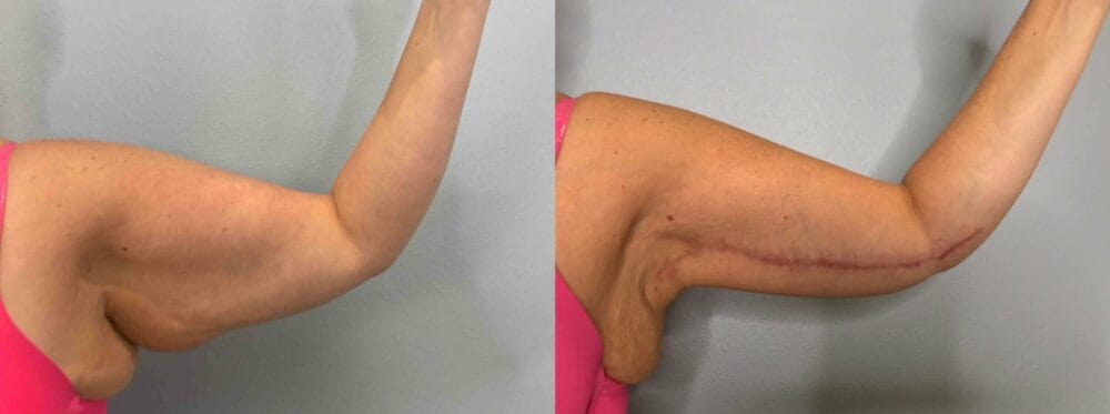 Arm Lift (Brachioplasty) Patient 5 front left view