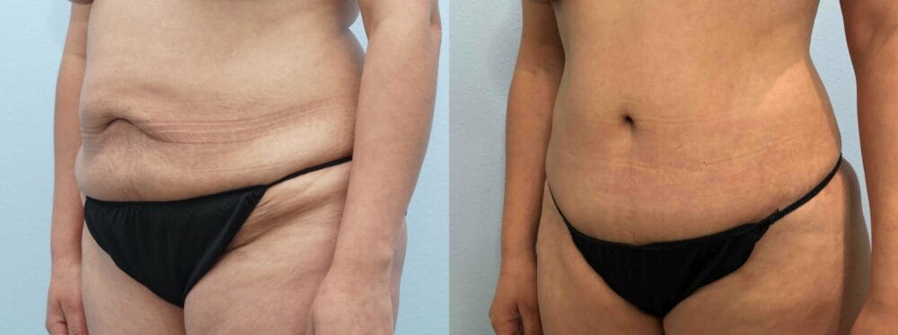 Tummy Tuck Patient 72 right angle view