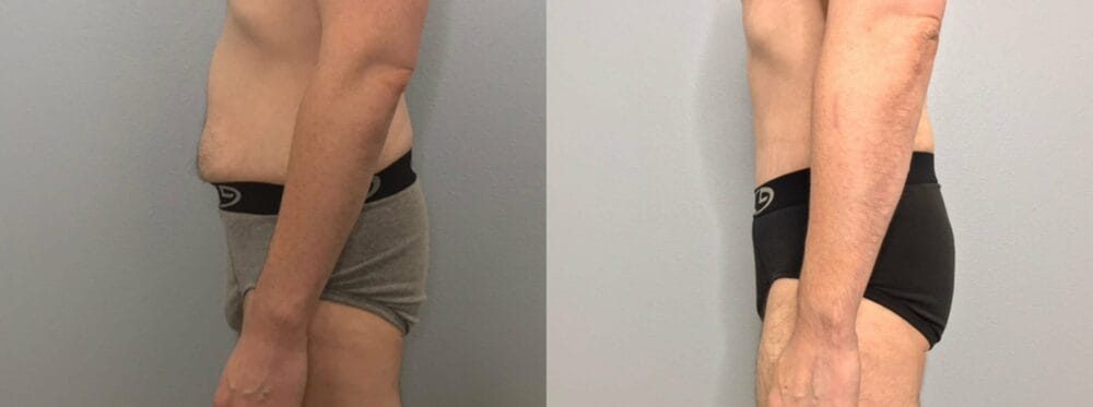 Tummy Tuck Patient 71 right view