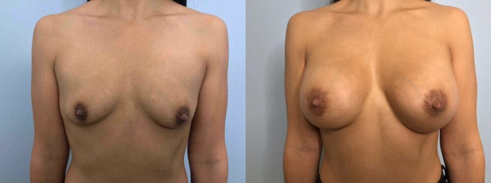 Breast Augmentation Patient 85 front view