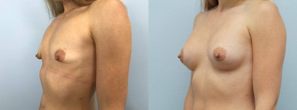 Breast Augmentation Patient 90 right angle view