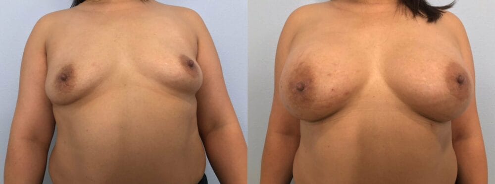 Breast Augmentation Patient 89 front view
