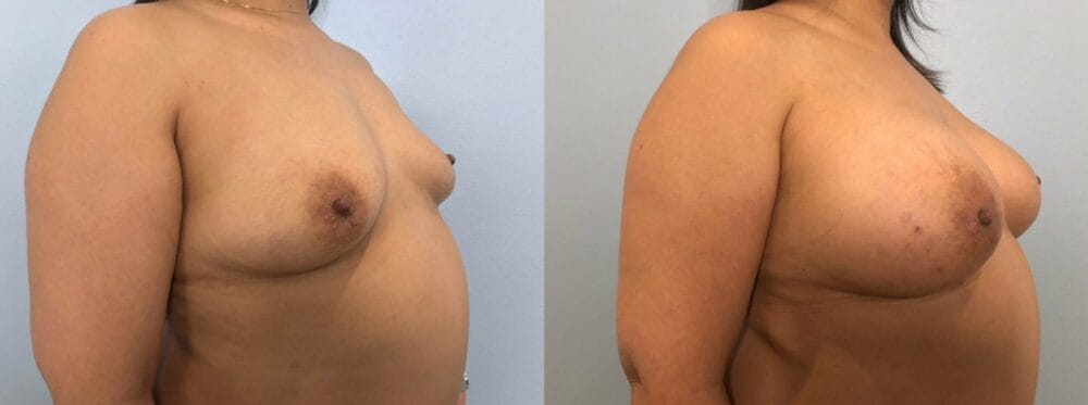 Breast Augmentation Patient 89 left angle view