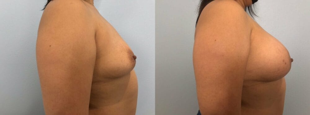 Breast Augmentation Patient 89 left view