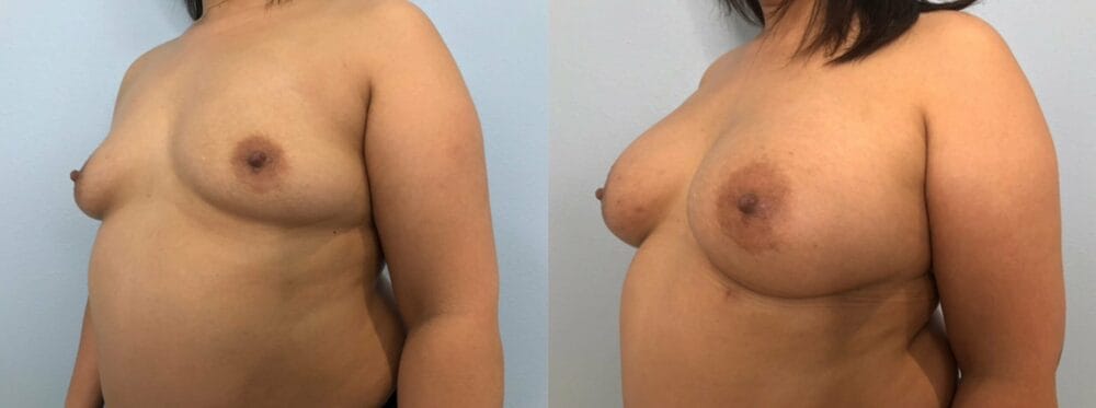 Breast Augmentation Patient 89 right angle view