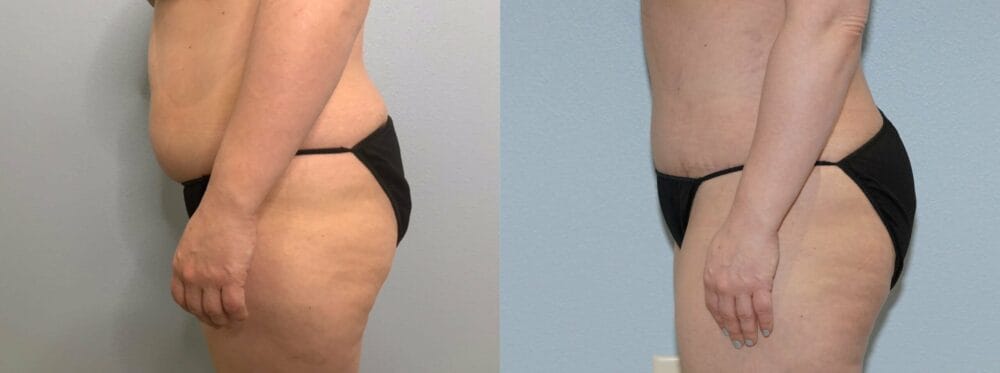 Tummy Tuck Patient 76 right view