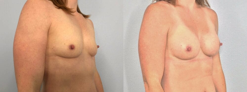 Breast Augmentation Patient 91 left angle view