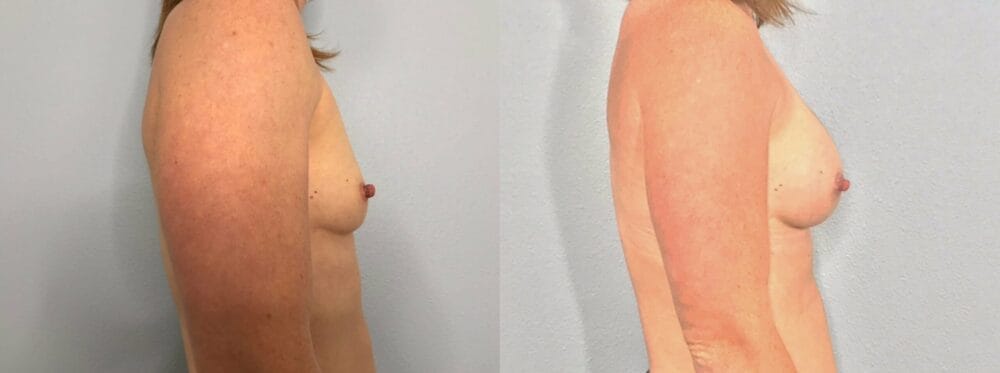 Breast Augmentation Patient 91 left view