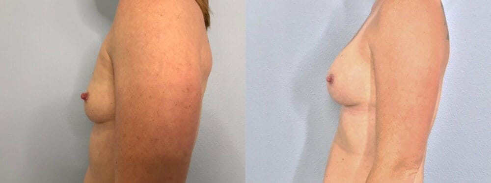 Breast Augmentation Patient 91 right view