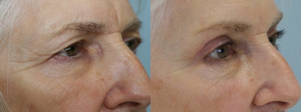 Eyelid Surgery (Blepharoplasty) Patient 20 left angle view