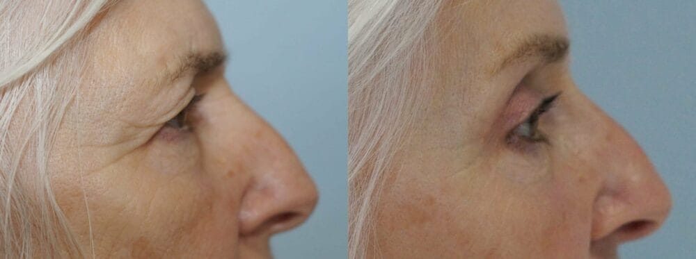 Eyelid Surgery (Blepharoplasty) Patient 20 left view